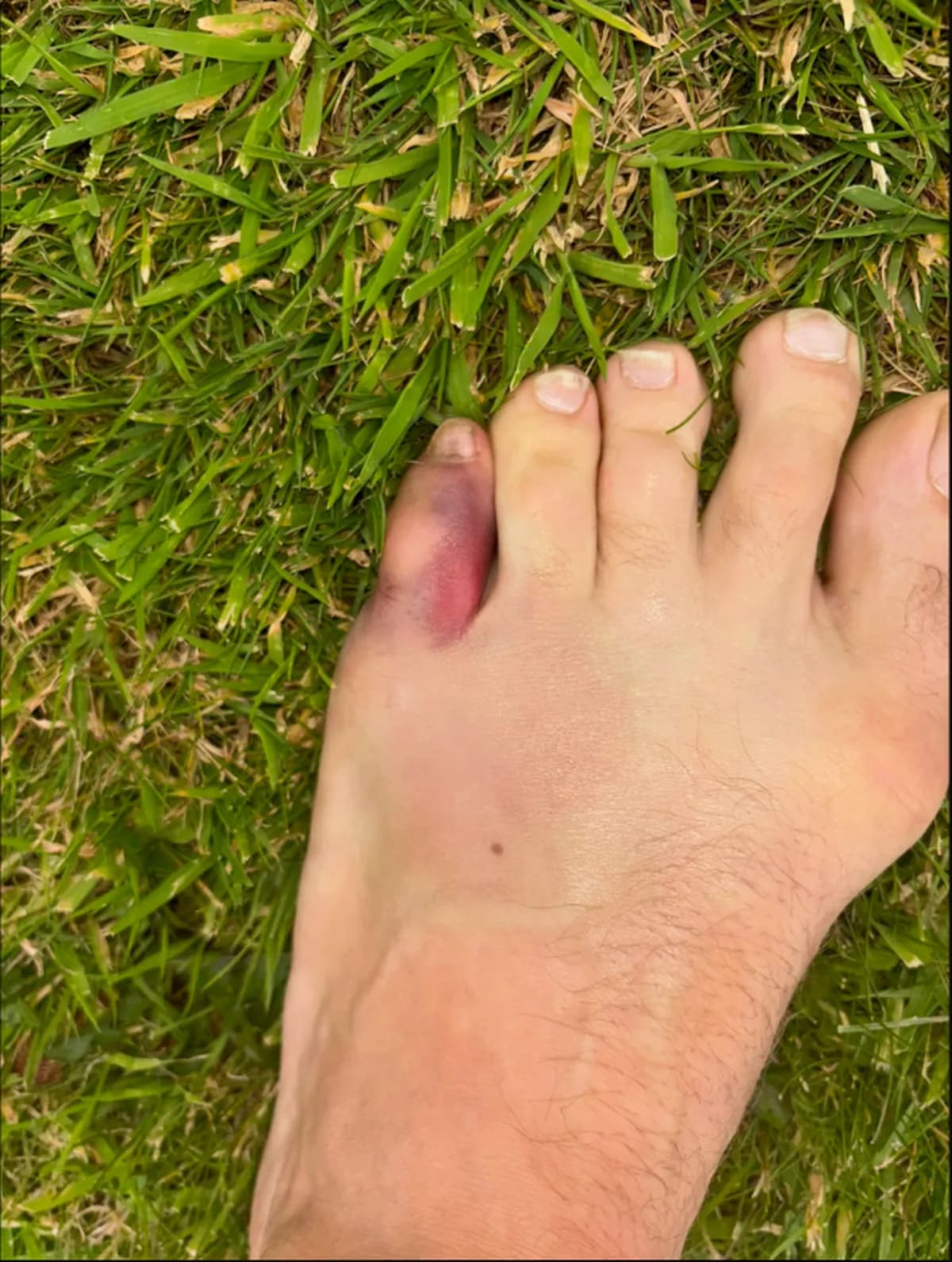 Conor McGregor shared a photo of his injured little toe