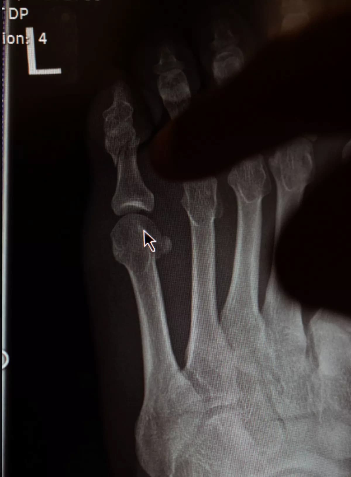 Conor McGregor shared a photo of his injured little toe Xray